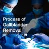 Process of Gallbladder Removal